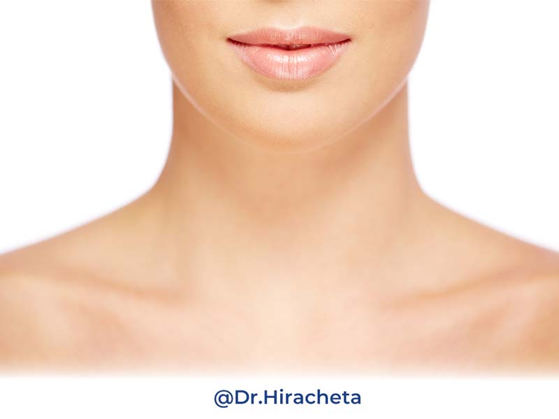 Lifting Cervical o liposuccion de cuello en chihuahua dr. alberto hiracheta torres cirujano plastico