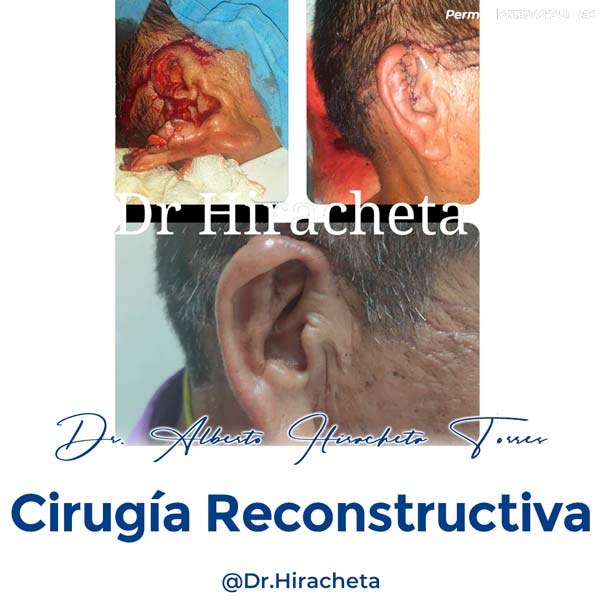 Paciente Cirugia Reconstructiva Dr. Alberto Hiracheta Torres Cirujano Plastico en Chihuahua 2