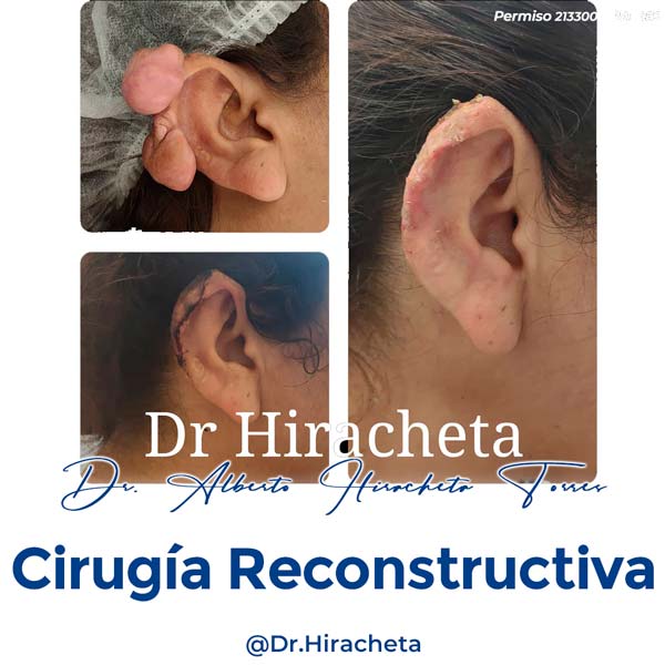 Paciente Cirugia Reconstructiva Dr. Alberto Hiracheta Torres Cirujano Plastico en Chihuahua 3