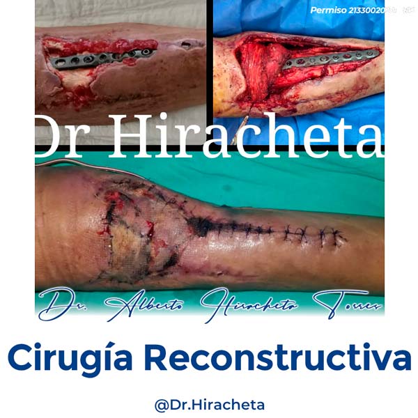 Paciente Cirugia Reconstructiva Dr. Alberto Hiracheta Torres Cirujano Plastico en Chihuahua 4