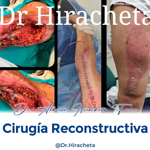 Paciente Cirugia Reconstructiva Dr. Alberto Hiracheta Torres Cirujano Plastico en Chihuahua 5