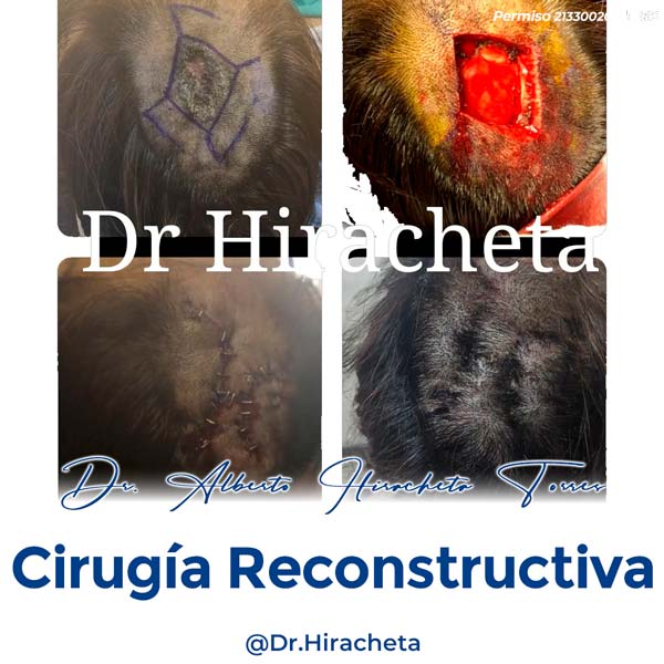 Paciente Cirugia Reconstructiva Dr. Alberto Hiracheta Torres Cirujano Plastico en Chihuahua 6