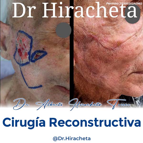 Paciente Cirugia Reconstructiva Dr. Alberto Hiracheta Torres Cirujano Plastico en Chihuahua 7