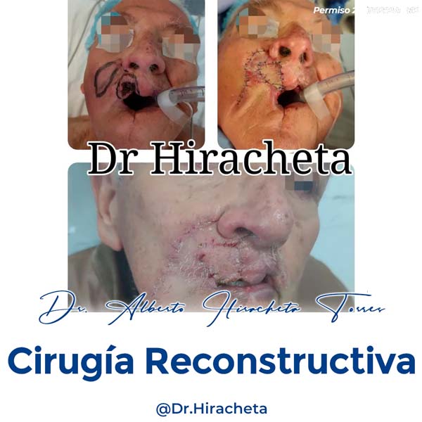 Paciente Cirugia Reconstructiva Dr. Alberto Hiracheta Torres Cirujano Plastico en Chihuahua 8