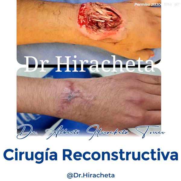 Paciente Cirugia Reconstructiva Dr. Alberto Hiracheta Torres Cirujano Plastico en Chihuahua