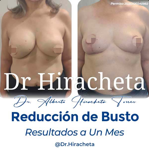 Reduccion de senos dr alberto hiracheta torres cirujano plastico en chihuahua paciente 1