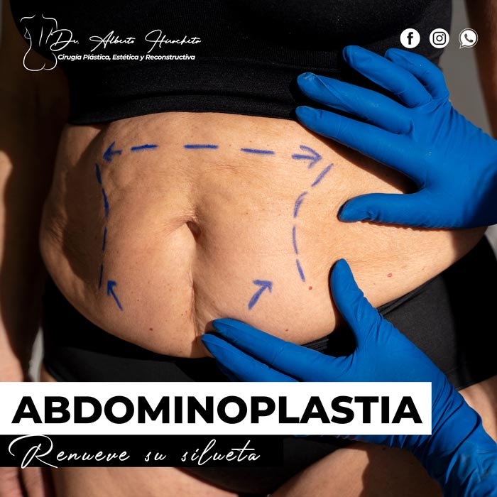 Abdominoplastia Dr Alberto Hiracheta Torres Cirujano plastico en chihuahua