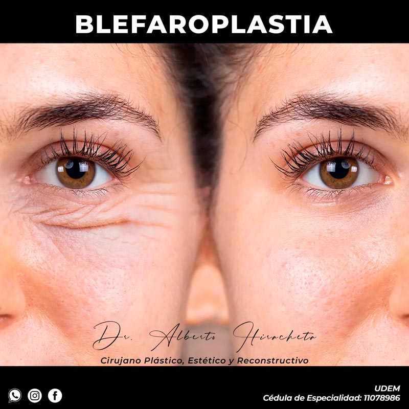 Blefaroplastia Dr Alberto Hiracheta Torres Cirujano plastico en chihuahua