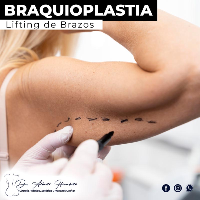 Braquioplastia Dr Alberto Hiracheta Torres Cirujano plastico en chihuahua