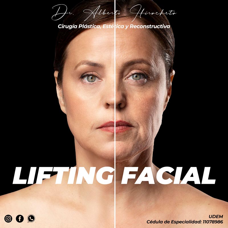 Lifting Facial Dr Alberto Hiracheta Torres Cirujano plastico en chihuahua