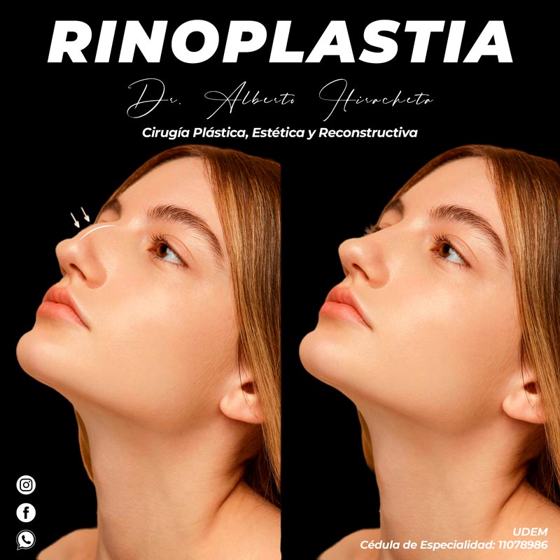 Rinoplastia Dr Alberto Hiracheta Torres Cirujano plastico en chihuahua